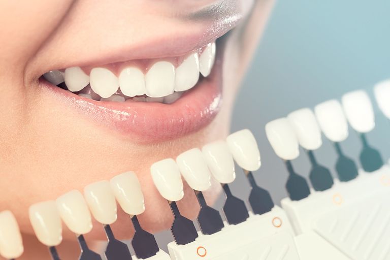 Giá răng sứ Veneer phụ thuộc vào nhiều yếu tố khác nhau