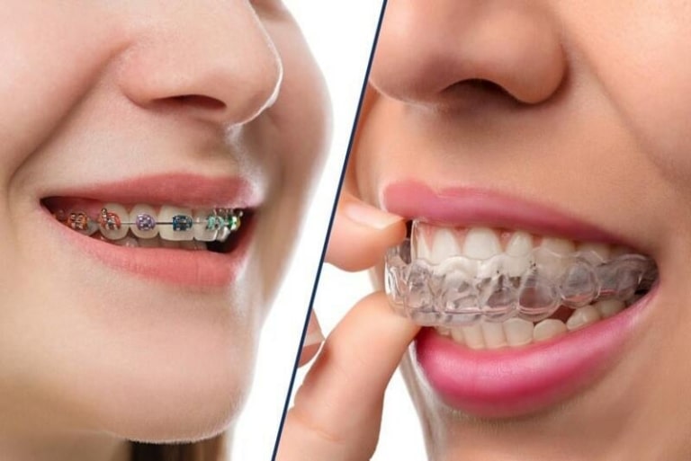 Chi phí niềng răng cũng phụ thuộc vào phương pháp mà bạn lựa chọn