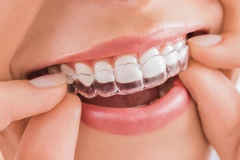 Niềng răng hô bằng nhựa là sử dụng bộ khay bằng nhựa dẻo trong suốt