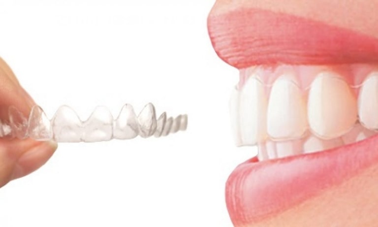Phương pháp niềng răng trong suốt có nhiều ưu điểm vượt trội hơn so với cách làm truyền thống