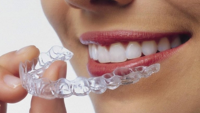 Niềng răng Invisalign là sáng chế của các nha khoa hàng đầu Hoa Kỳ