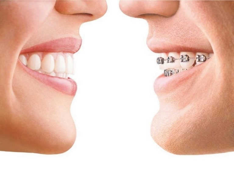 Quy trình niềng răng hô cằm lẹm được thực hiện chuẩn theo Bộ Y tế