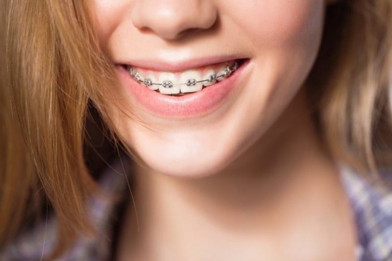 Niềng răng hô cằm lẹm với phương pháp niềng răng mắc cài kim loại được sử dụng phổ biến nhất