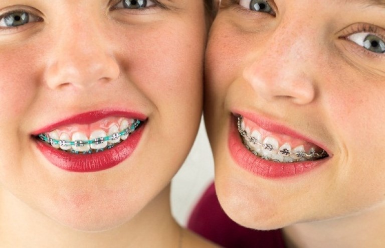 Răng bị hô hàm trên có niềng được không là câu hỏi mà nhiều người thắc mắc