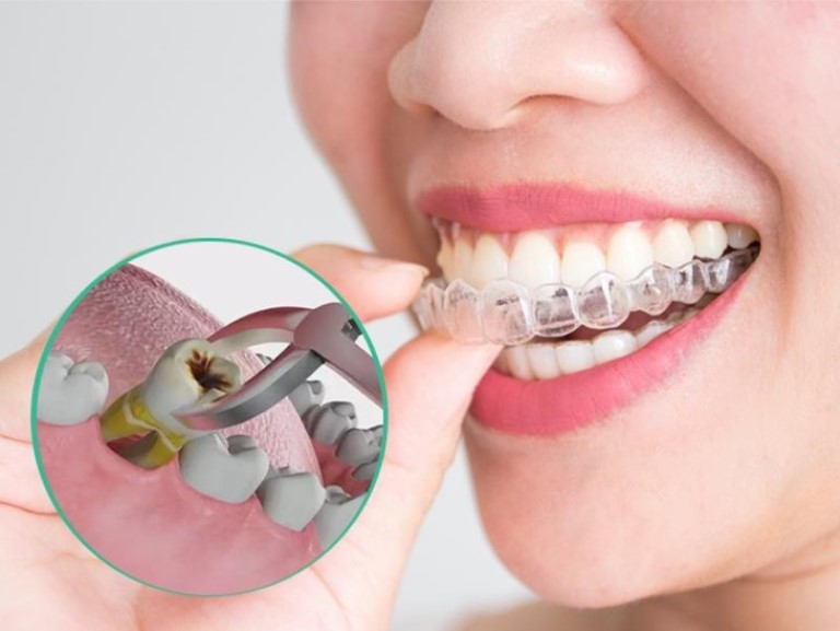 Niềng răng hô hàm trên có cần nhổ răng hay không phụ thuộc vào tình trạng răng miệng của bạn