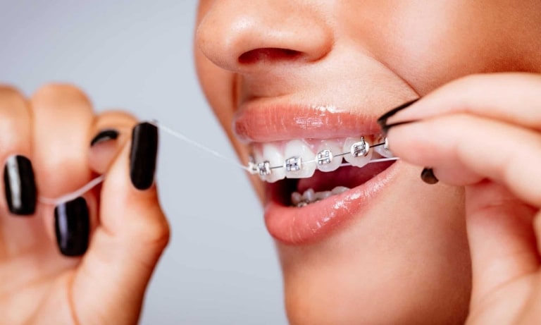Quá trình niềng răng đòi hỏi người bệnh cần chú ý đến việc chăm sóc răng miệng, ăn uống