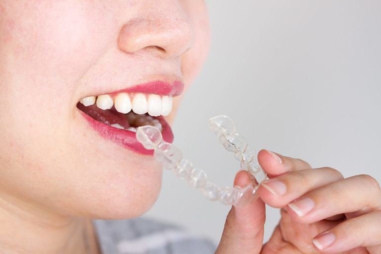 Niềng răng không mắc cài 3D Clear không sử dụng dây cung mắc cài 