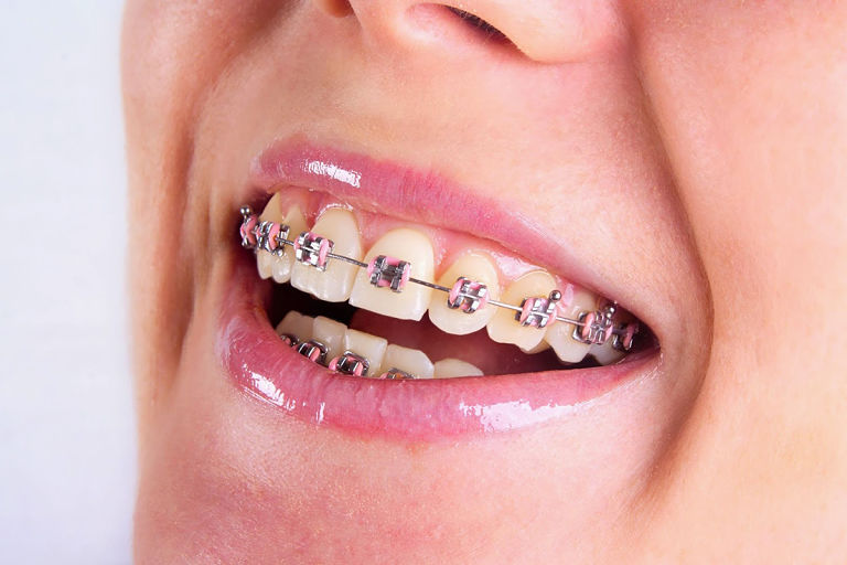 Niềng răng mắc cài là phương pháp chỉnh răng khá hiệu quả