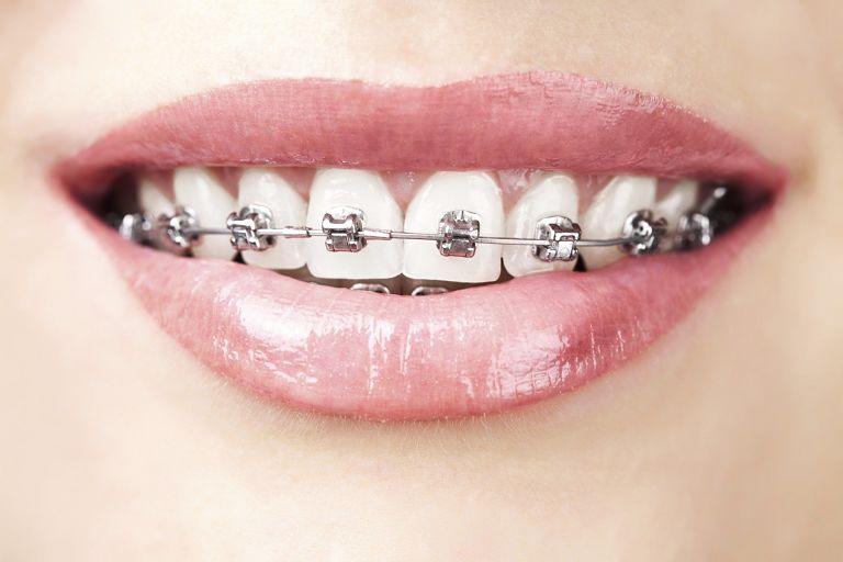 Niềng răng mắc cài kim loại mang lại hiệu quả chỉnh nha tốt