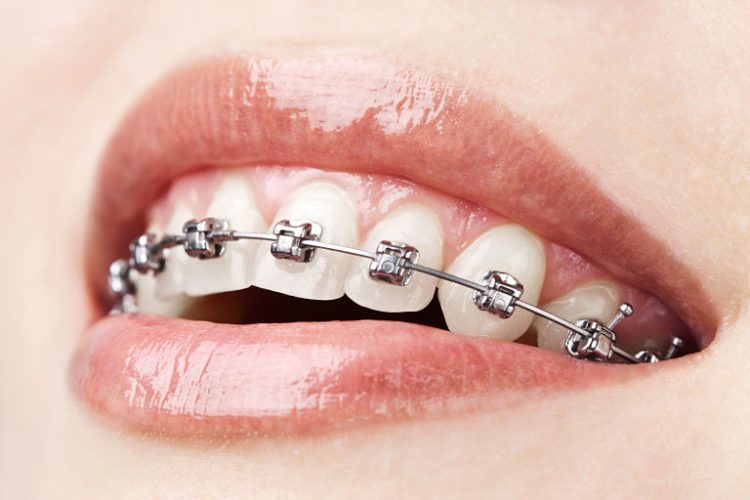 Niềng răng mắc cài kim loại là kỹ thuật gì? Một số thông tin bạn cần biết