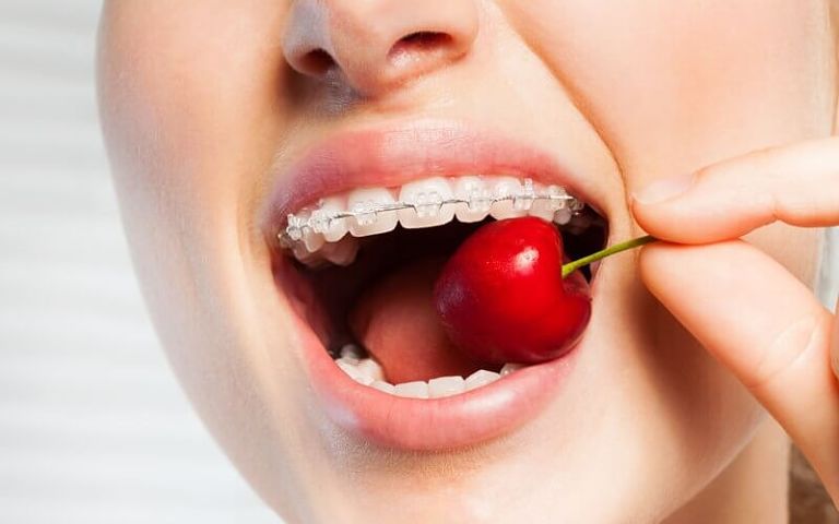 Bạn cần bổ sung nhiều loại trái cây tốt cho răng miệng trong quá trình niềng răng