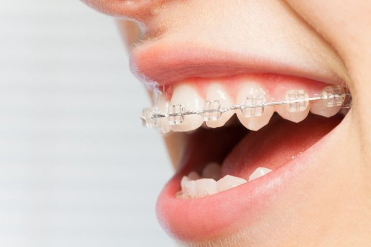 Niềng răng mắc cài sứ dây trong là kỹ thuật gì? Phương pháp này có tốt không?