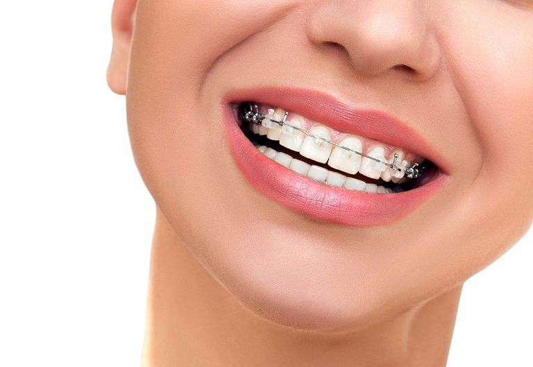 Niềng răng mắc cài sứ tự buộc mang đến nhiều ưu điểm cho người dùng