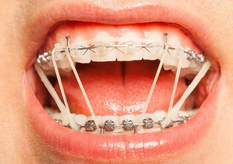 Niềng răng tại nhà bằng mắc cài tự chế khá phổ biến hiện nay