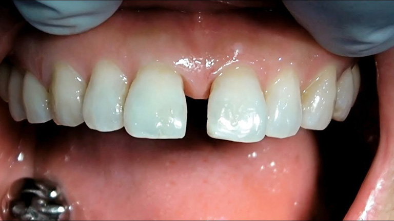 Răng thưa là tình trạng giữa các răng có các khe hở