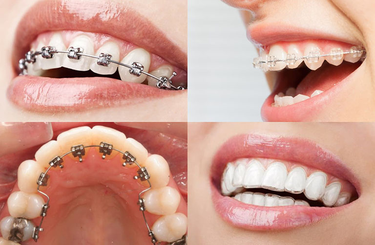 Những phương pháp niềng răng thưa phổ biến nhất hiện nay