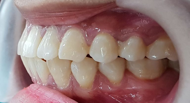 Răng hô nặng cần được điều trị bằng phương pháp nha khoa chuyên sâu