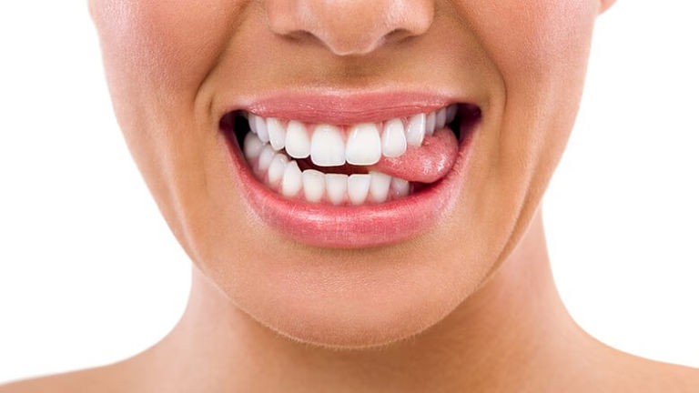 Dùng lưỡi đẩy giúp chỉnh răng hô nặng nhưng không cho kết quả cao