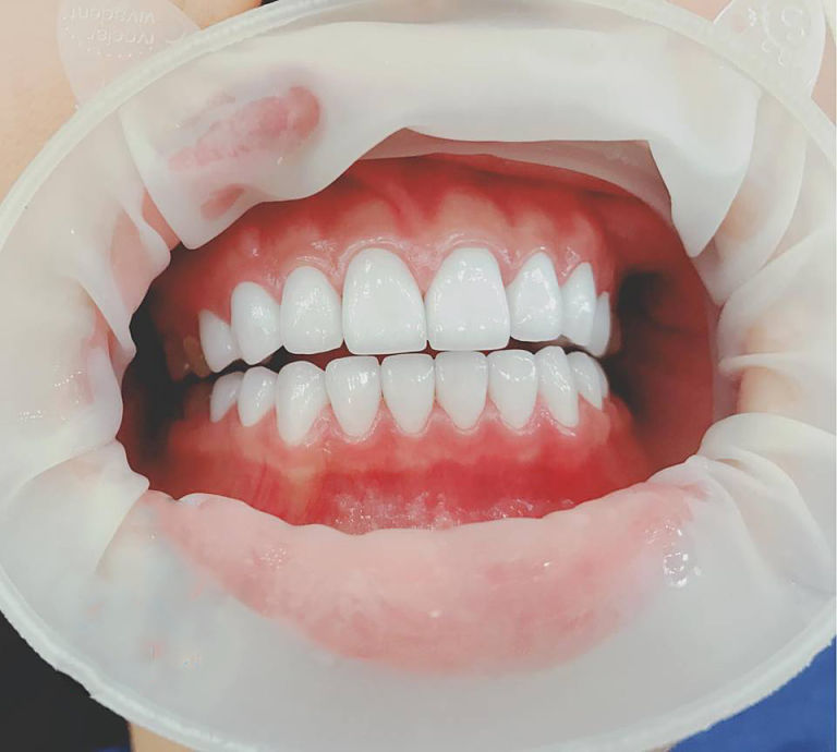 Bọc răng sứ là cách điều trị răng bị vâu hiệu quả bạn nên lựa chọn