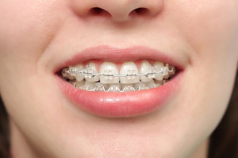 Niềng răng giúp khắc phục tình trạng răng hô hiệu quả