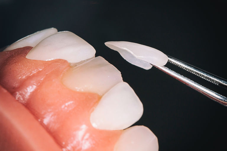 Răng sứ Veneer là phương pháp chỉnh nha phổ biến hiện nay