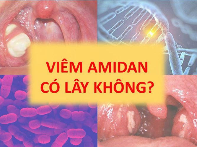 Bệnh viêm amidan có lây không là thắc mắc của khá nhiều người bệnh khi không may bị bệnh lý này