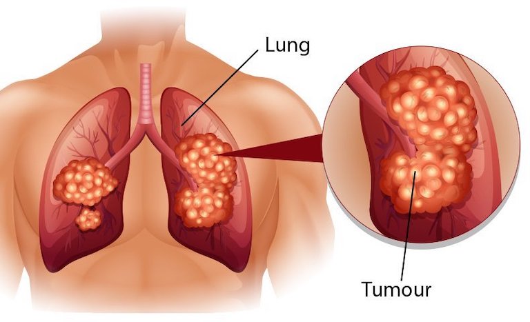 Bệnh có khả năng gây ra biến chứng ung thư phổi nguy hiểm