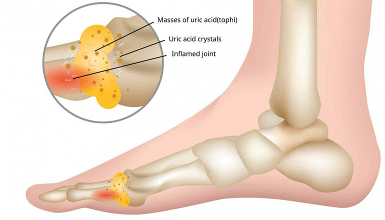 Bệnh Gout Thường Đau Ở Đâu? Làm Gì Để Cải Thiện Bệnh Tốt Nhất?