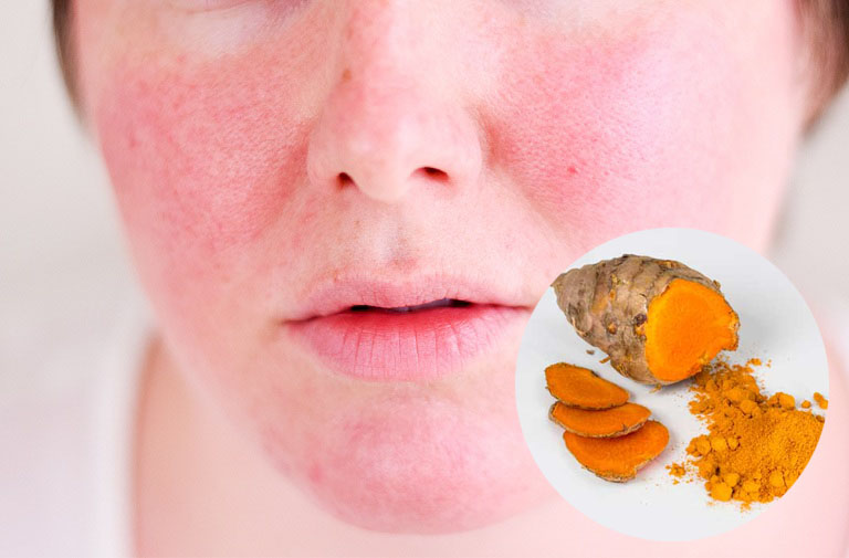 Mẹo chữa dị ứng da mặt bằng nghệ mang đến nhiều tác dụng cho sức khỏe làn da