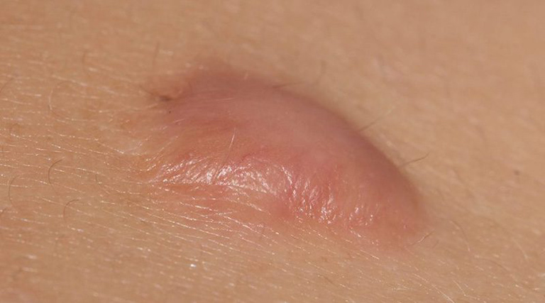 Sẹo lồi được hình thành trên da như một khối u lành tính