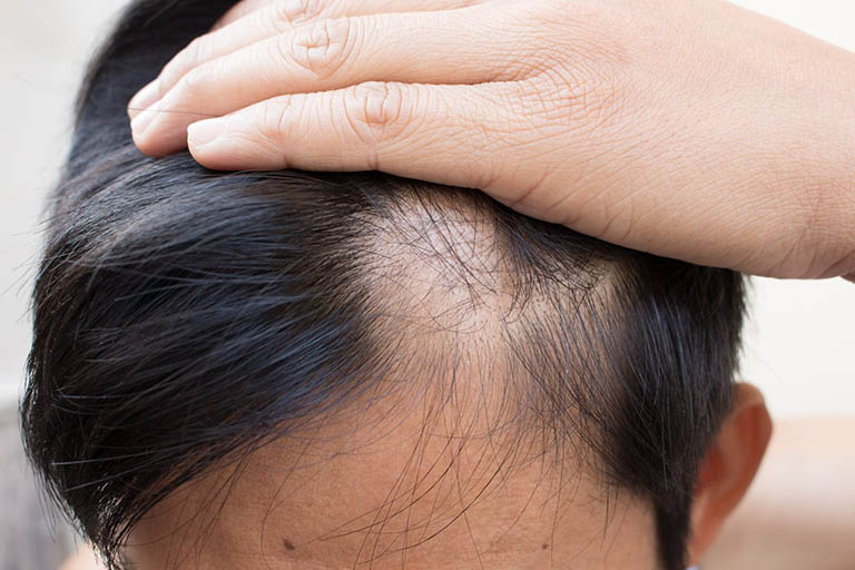 Rụng tóc từng mảng mô tả căn bệnh dẫn đến các mảng hói trên da đầu