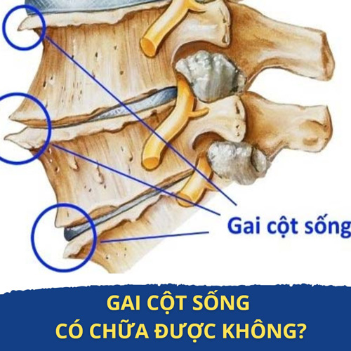 Gai Cột Sống Có Chữa Được Không? Cách Điều Trị Nào Hiệu Quả Nhất?