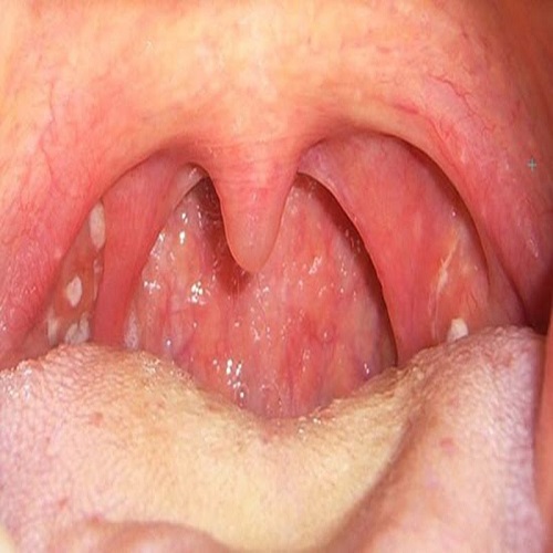 Viêm họng kéo dài có thể biến chứng thành viêm amidan