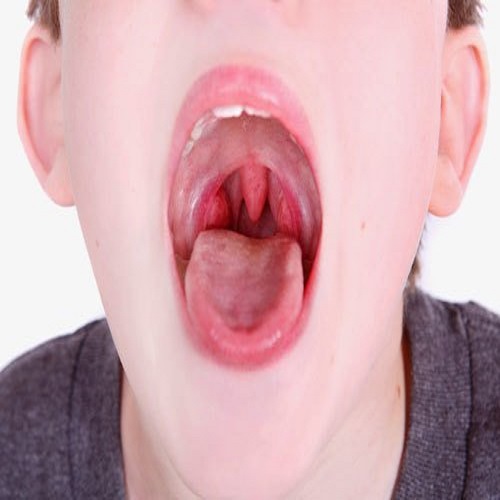 Viêm họng ở trẻ là một trong những bệnh lý về hô hấp phổ biến