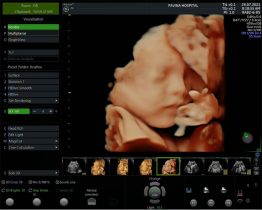 Siêu âm 5D giúp mẹ có thể quan sát rõ nét chuyển động của thai nhi