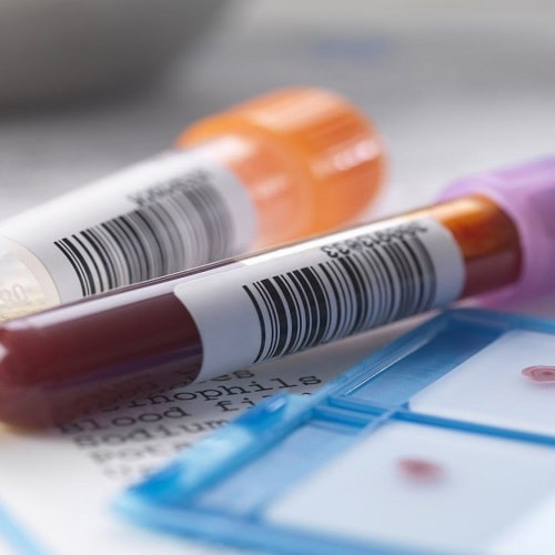 Các xét nghiệm máu giúp chẩn đoán bệnh chi tiết