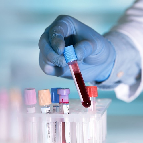 Xét nghiệm máu giúp chẩn đoán vi khuẩn HP