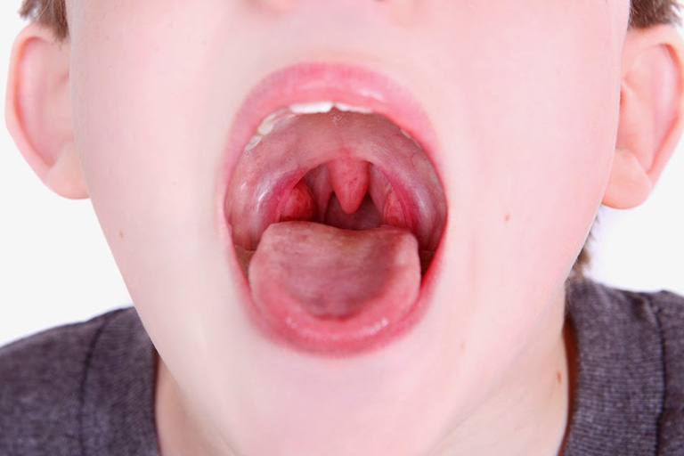 Viêm họng cấp ở trẻ em