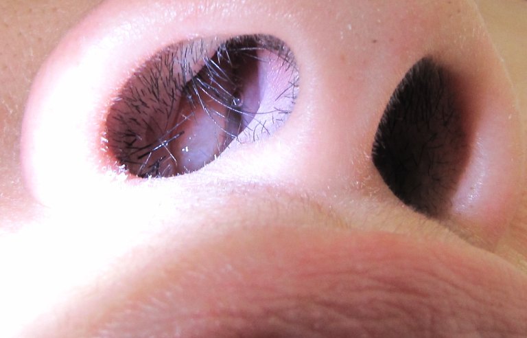 Polyp mũi là hiện tượng mũi xuất hiện khối mềm không đau