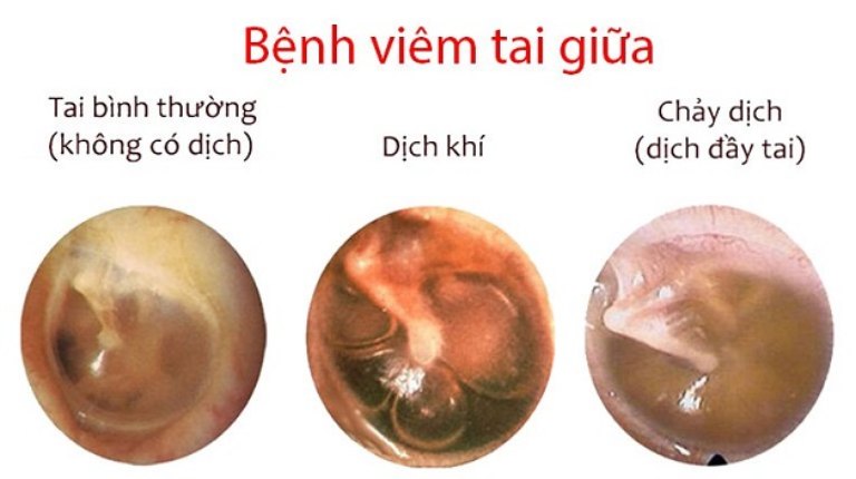 Viêm tai giữa là bệnh thường gặp ở trẻ từ 6 - 36 tháng tuổi