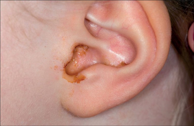 Đau tai, chảy nhiều dịch lỏng hoặc mủ tai là triệu chứng đặc trưng của bệnh