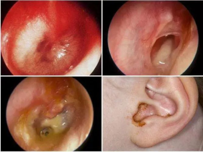 Viêm tai giữa có mủ là tình trạng viêm, ứ mủ trong tai giữa