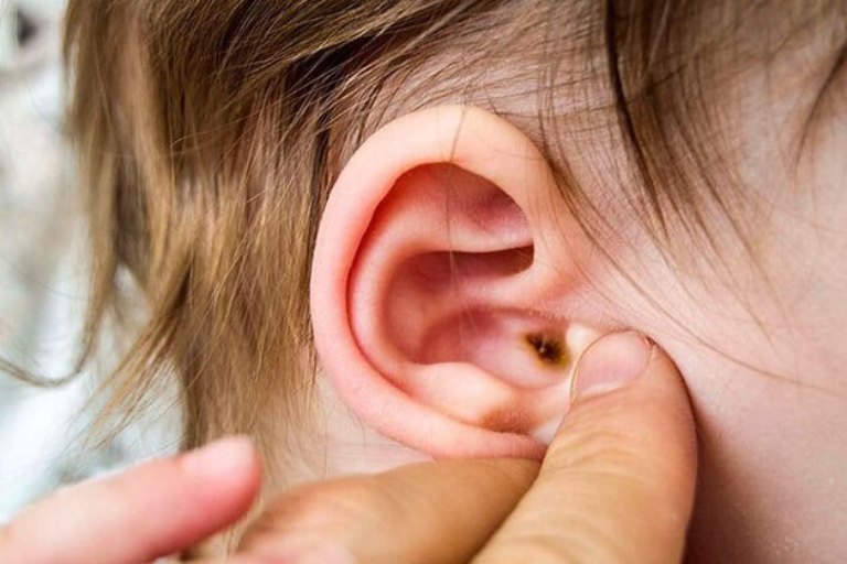 Viêm tai giữa là bệnh lý nhiễm trùng tai giữa thường gặp ở trẻ em