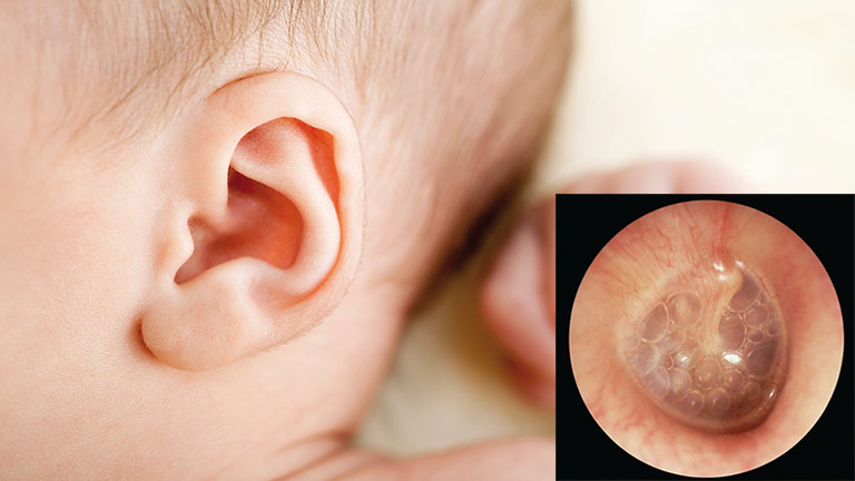 viêm tai giữa ứ dịch ở trẻ em