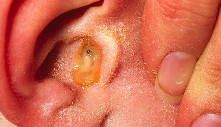 Viêm tai giữa xung huyết gây rò rỉ dịch vàng ra ngoài tai