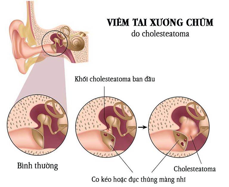 Bệnh viêm tai xương chũm có cholesteatoma gây ra triệu chứng đau tai, chảy mủ tai kéo dài nhiều tháng
