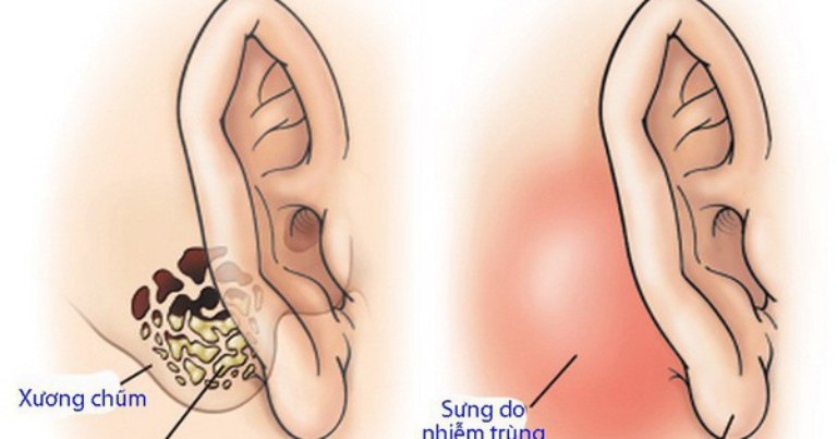 Viêm tai xương chũm mạn tính là do viêm tai giữa, viêm tai xương chũm không được điều trị kịp thời, đúng cách
