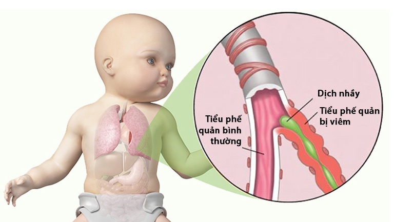 Viêm tiểu phế quản bội nhiễm thường gây ảnh hưởng đến trẻ em dưới 1 tuổi do hệ hô hấp chưa phát triển hoàn thiện