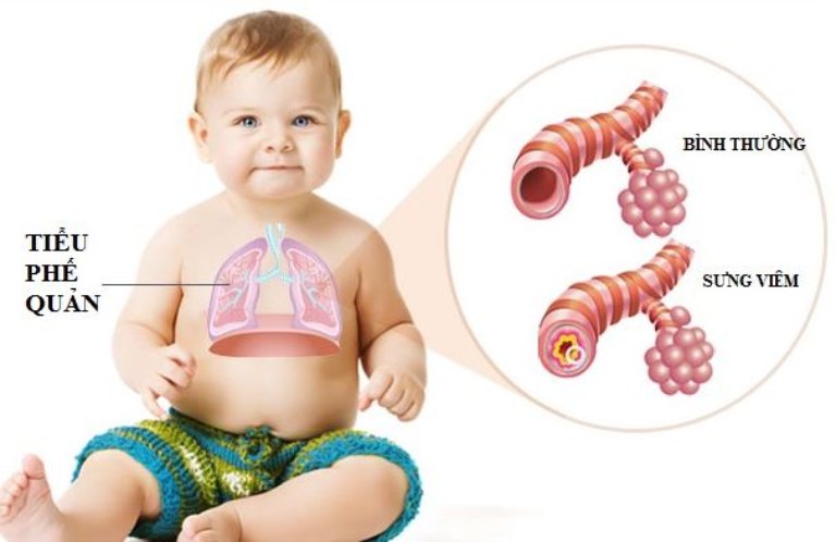 Viêm tiểu phế quản ở trẻ em là bệnh về hô hấp thường gặp