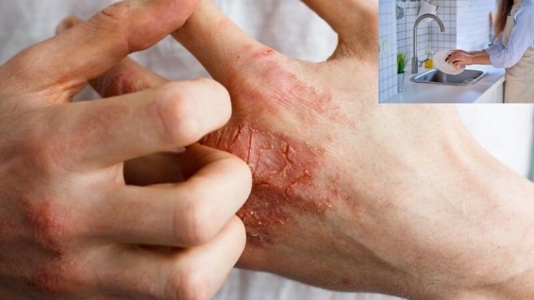 Viêm da tiếp xúc có 2 dạng chính là viêm da tiếp xúc dị ứng và viêm da tiếp xúc kích ứng